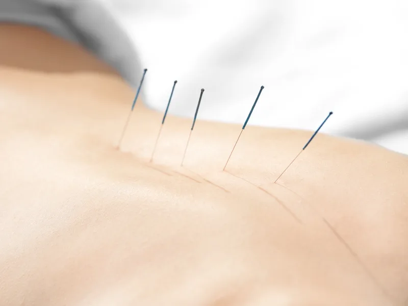 Acupuncture at Melbourne Chiropractic Spine & Injury Center in Palm Bay