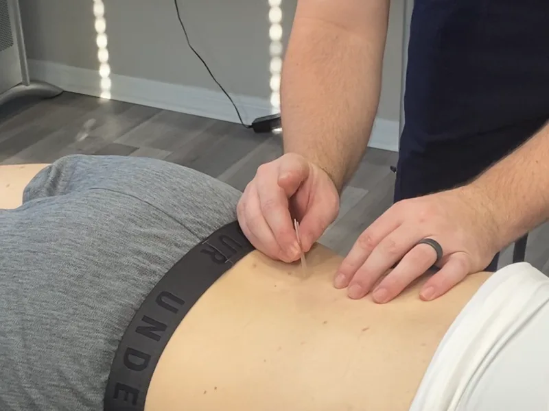How Dry Needling works at Melbourne Chiropractic Spine & Injury Center