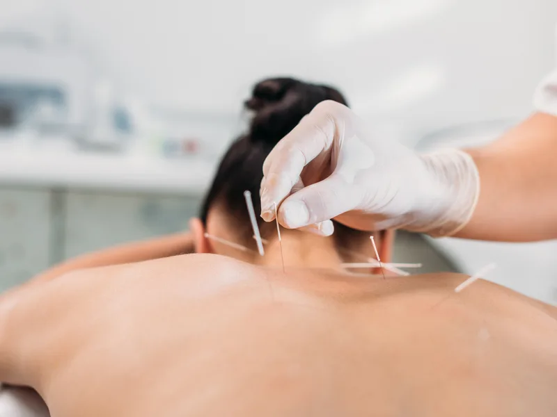 Dry Needling at Melbourne Chiropractic Spine & Injury Center in Palm Bay